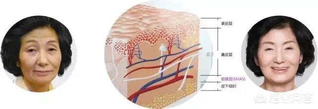 超声刀危害有哪些？