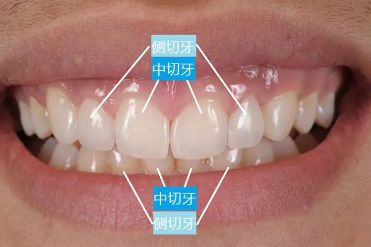 第二颗门牙图片